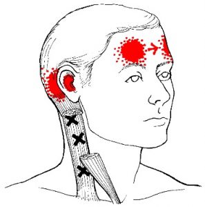 Sternocleidomastoid Trigger Points clavicular branch 