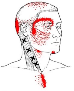 Sternocleidomastoid trigger points sternal branch
