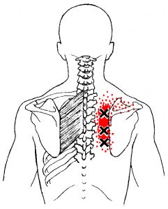 Rhomboid muscle trigger points