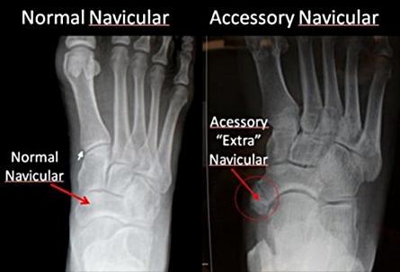 extra navicular bone xray