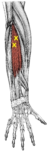extensor digitorum trigger points