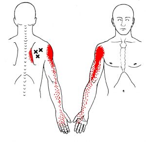 Infraspinatus Trigger Points and Referred Pain | Trigger Point Self-Help