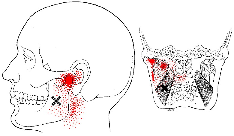 medial pterygoid muscle trigger points