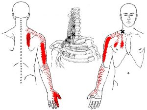 scalene muscle trigger points