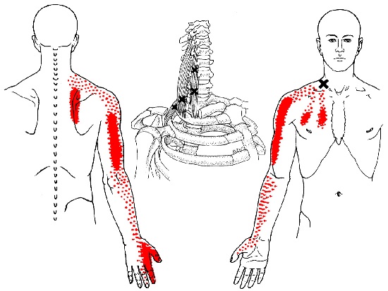scalene muscle trigger points