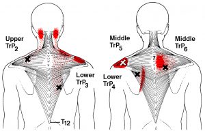 Trapezius muscle trigger points