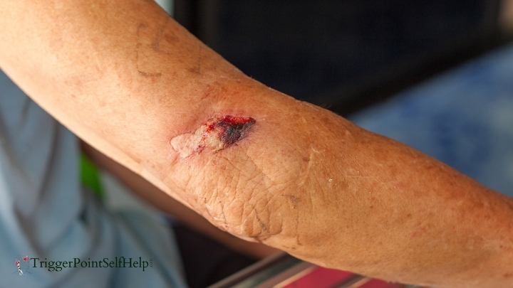 severe arm abrasion